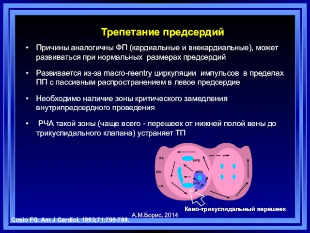 Трепетание предсердий Причины аналогичны ФП (кардиальные и внекардиальные), может развиваться при