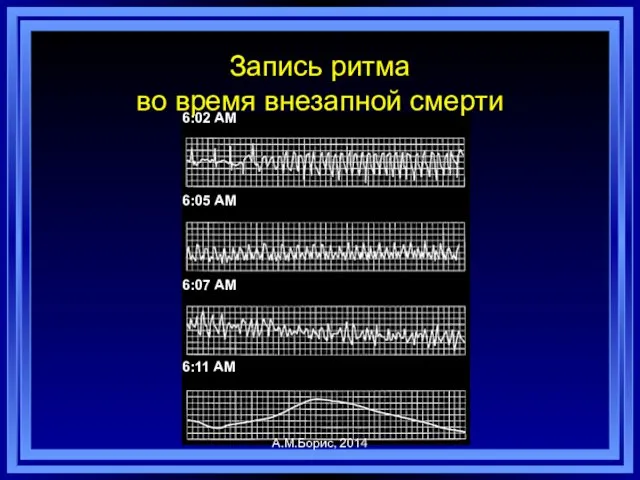 Запись ритма во время внезапной смерти 6:02 AM 6:05 AM 6:07 AM 6:11 AM А.М.Борис, 2014