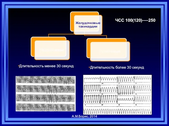 Длительность менее 30 секунд Длительность более 30 секунд А.М.Борис, 2014 ЧСС 100(120)──250
