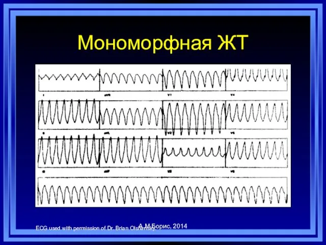 Мономорфная ЖТ ECG used with permission of Dr. Brian Olshansky. А.М.Борис, 2014