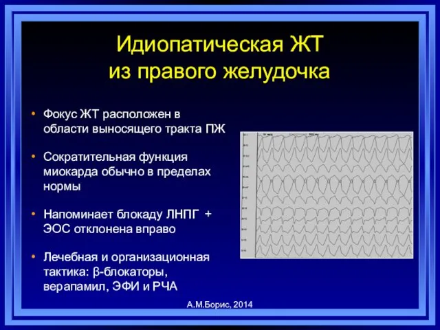 Идиопатическая ЖТ из правого желудочка Фокус ЖТ расположен в области выносящего