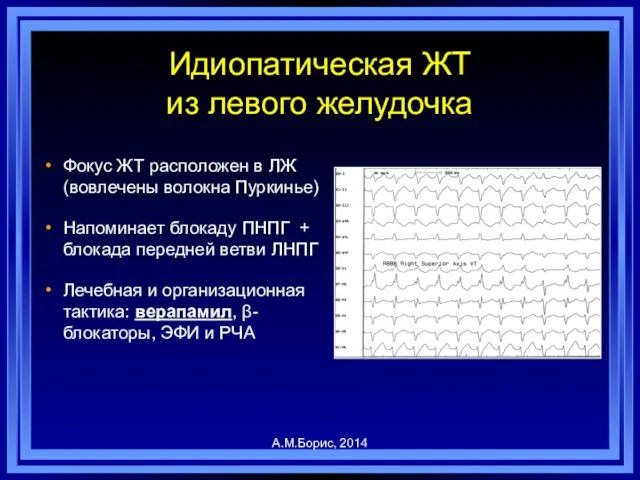 Идиопатическая ЖТ из левого желудочка Фокус ЖТ расположен в ЛЖ (вовлечены