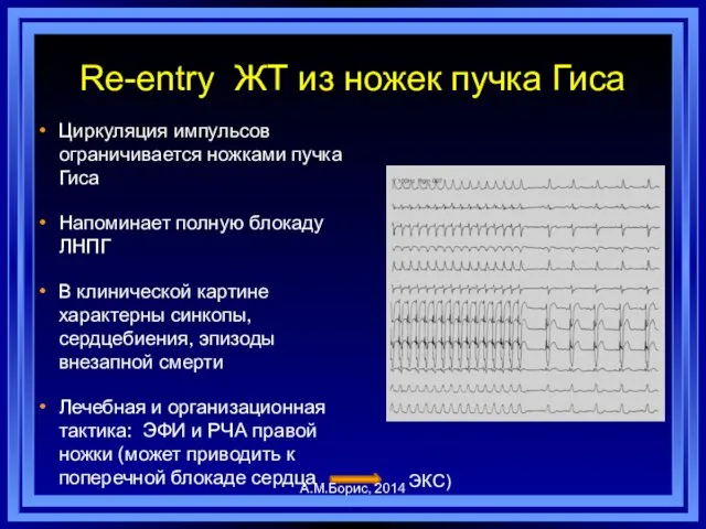 Re-entry ЖТ из ножек пучка Гиса Циркуляция импульсов ограничивается ножками пучка