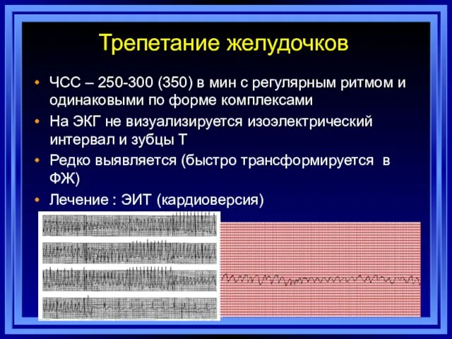 Трепетание желудочков ЧСС – 250-300 (350) в мин с регулярным ритмом