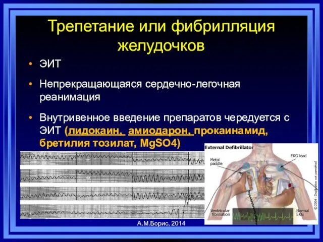 Трепетание или фибрилляция желудочков ЭИТ Непрекращающаяся сердечно-легочная реанимация Внутривенное введение препаратов