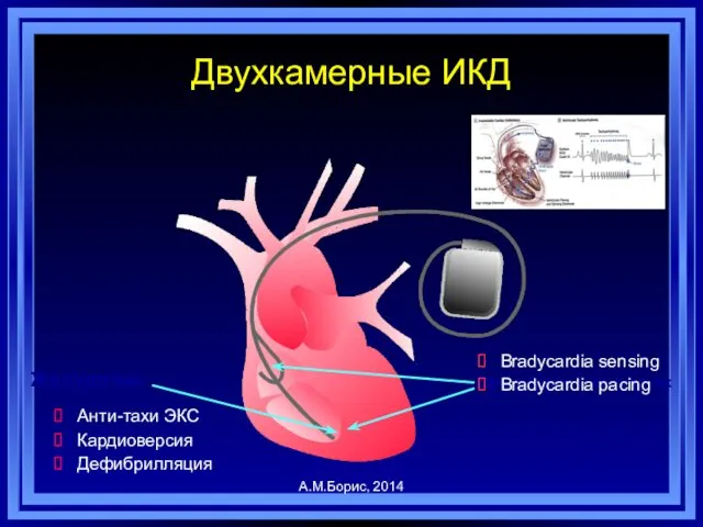 Предсердие + желудочек Желудочек Двухкамерные ИКД Анти-тахи ЭКС Кардиоверсия Дефибрилляция Bradycardia sensing Bradycardia pacing А.М.Борис, 2014