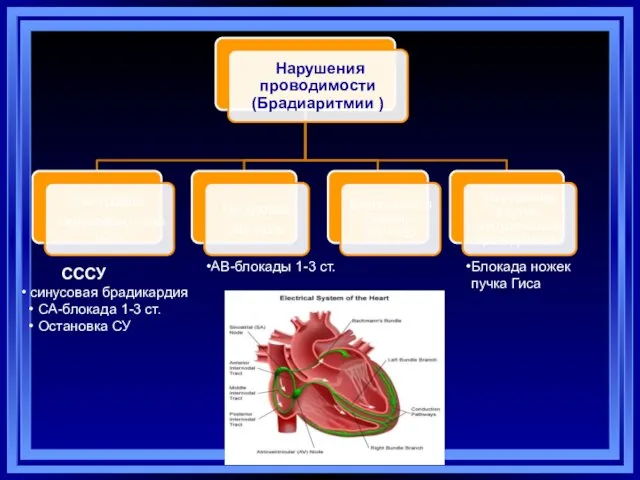 СССУ синусовая брадикардия СА-блокада 1-3 ст. Остановка СУ АВ-блокады 1-3 ст.