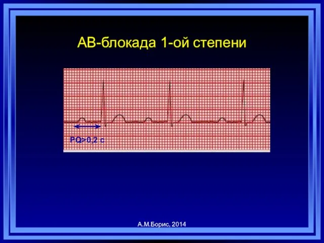 АВ-блокада 1-ой степени А.М.Борис, 2014 PQ>0,2 c