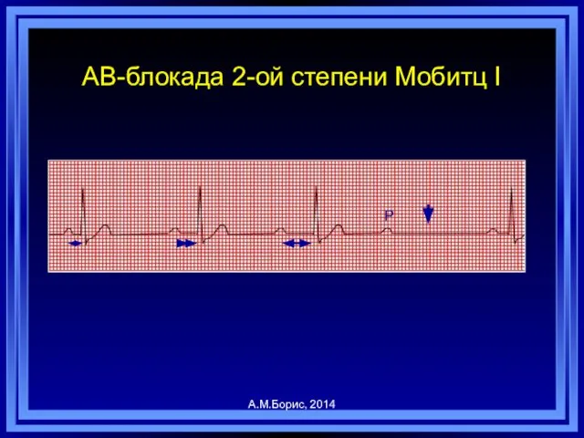 АВ-блокада 2-ой степени Мобитц I P А.М.Борис, 2014