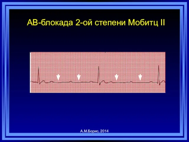 АВ-блокада 2-ой степени Мобитц II А.М.Борис, 2014