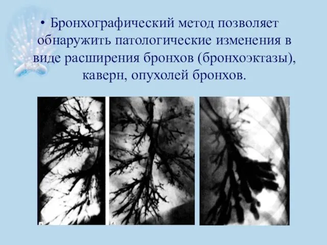 Бронхографический метод позволяет обнаружить патологические изменения в виде расширения бронхов (бронхоэктазы), каверн, опухолей бронхов.