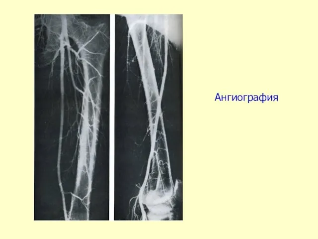 Ангиография