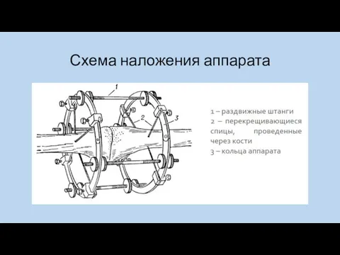 Схема наложения аппарата