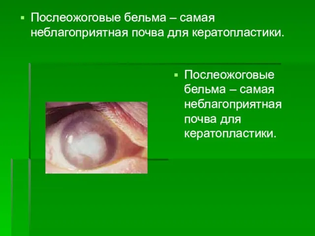 Послеожоговые бельма – самая неблагоприятная почва для кератопластики. Послеожоговые бельма – самая неблагоприятная почва для кератопластики.