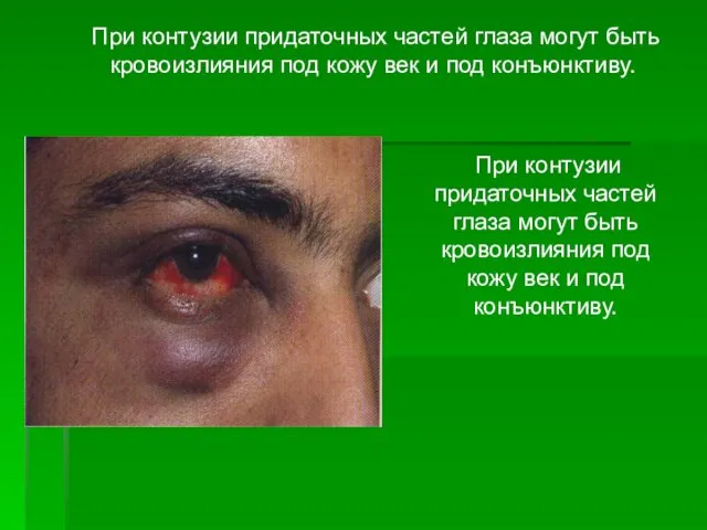 При контузии придаточных частей глаза могут быть кровоизлияния под кожу век