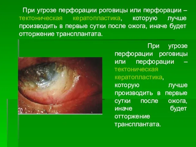 При угрозе перфорации роговицы или перфорации – тектоническая кератопластика, которую лучше
