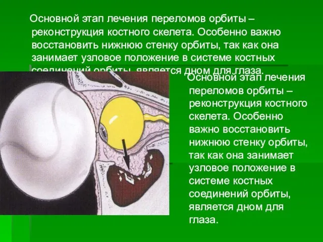 Основной этап лечения переломов орбиты – реконструкция костного скелета. Особенно важно