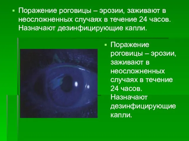 Поражение роговицы – эрозии, заживают в неосложненных случаях в течение 24