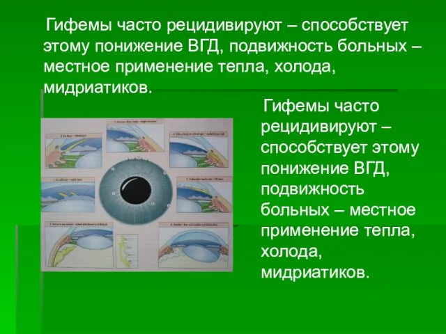 Гифемы часто рецидивируют – способствует этому понижение ВГД, подвижность больных –