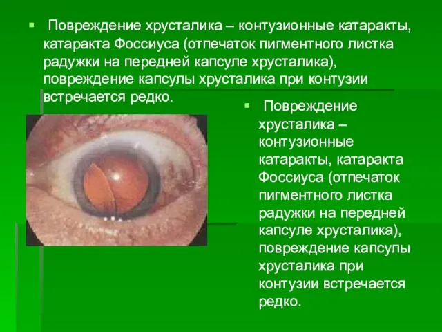 Повреждение хрусталика – контузионные катаракты, катаракта Фоссиуса (отпечаток пигментного листка радужки