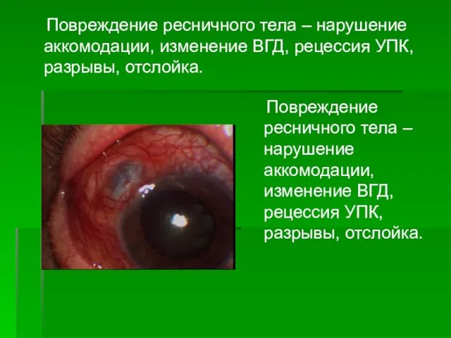 Повреждение ресничного тела – нарушение аккомодации, изменение ВГД, рецессия УПК, разрывы,