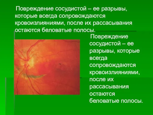 Повреждение сосудистой – ее разрывы, которые всегда сопровождаются кровоизлияниями, после их