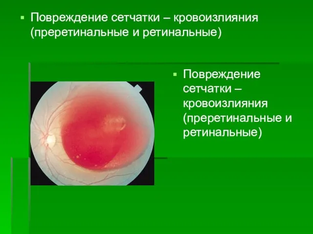 Повреждение сетчатки – кровоизлияния (преретинальные и ретинальные) Повреждение сетчатки – кровоизлияния (преретинальные и ретинальные)