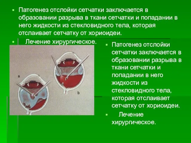 Патогенез отслойки сетчатки заключается в образовании разрыва в ткани сетчатки и