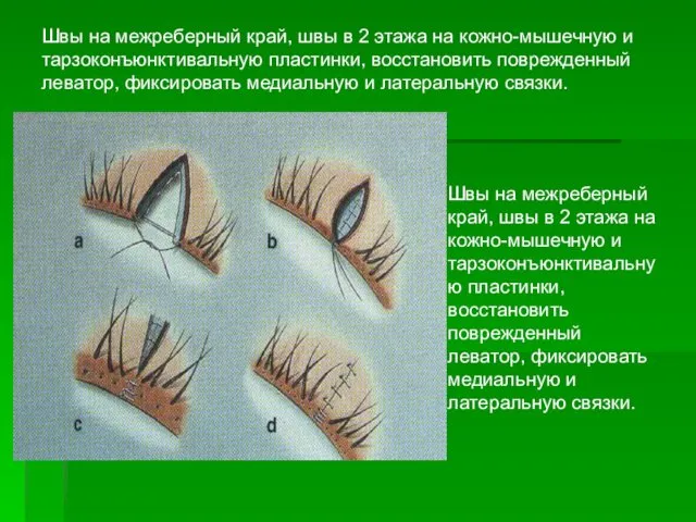 Швы на межреберный край, швы в 2 этажа на кожно-мышечную и