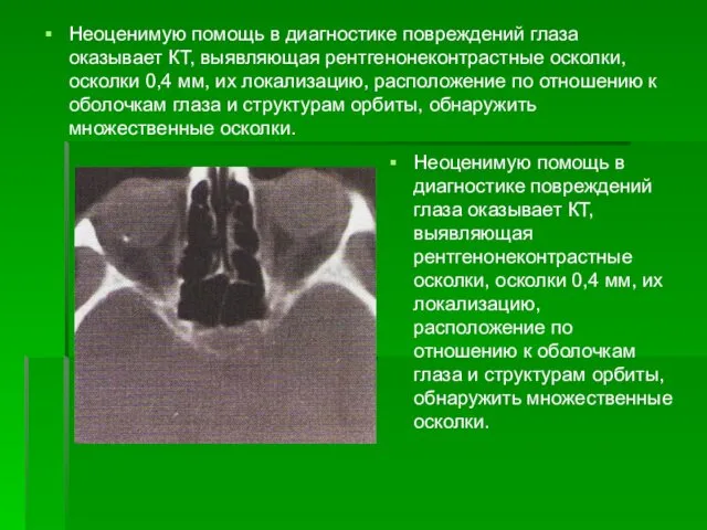 Неоценимую помощь в диагностике повреждений глаза оказывает КТ, выявляющая рентгенонеконтрастные осколки,