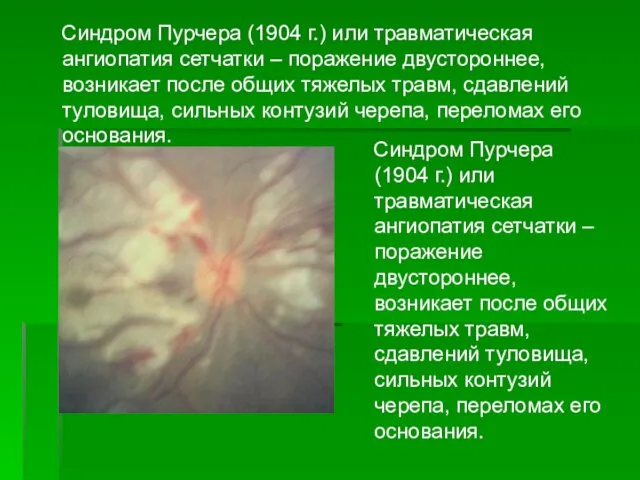 Синдром Пурчера (1904 г.) или травматическая ангиопатия сетчатки – поражение двустороннее,