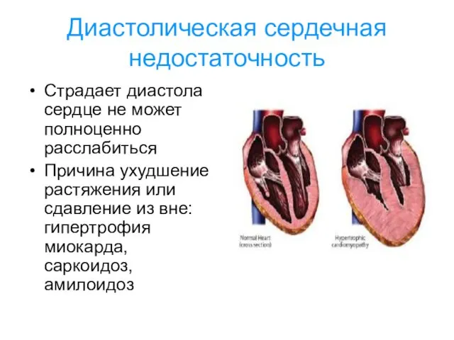 Диастолическая сердечная недостаточность Страдает диастола сердце не может полноценно расслабиться Причина