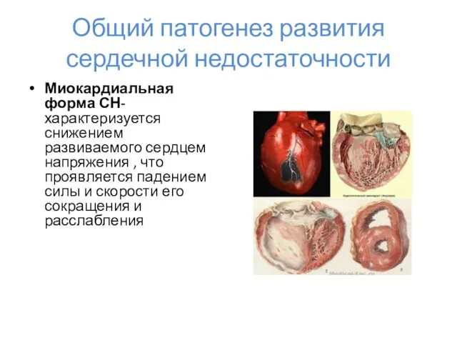 Общий патогенез развития сердечной недостаточности Миокардиальная форма СН- характеризуется снижением развиваемого