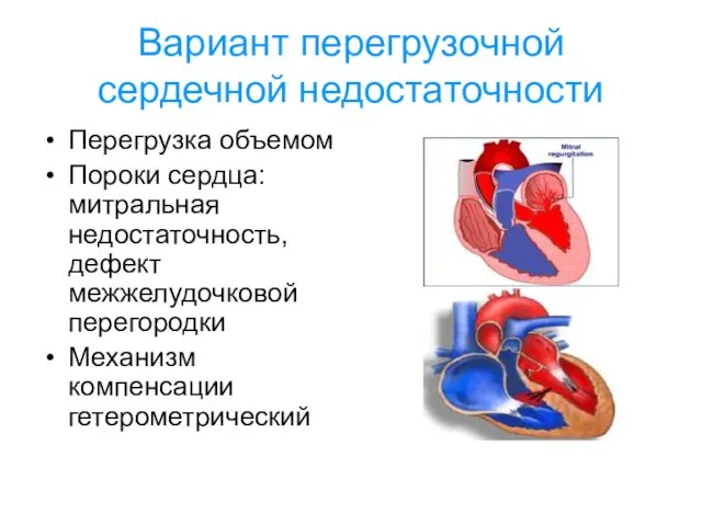 Вариант перегрузочной сердечной недостаточности Перегрузка объемом Пороки сердца: митральная недостаточность, дефект межжелудочковой перегородки Механизм компенсации гетерометрический