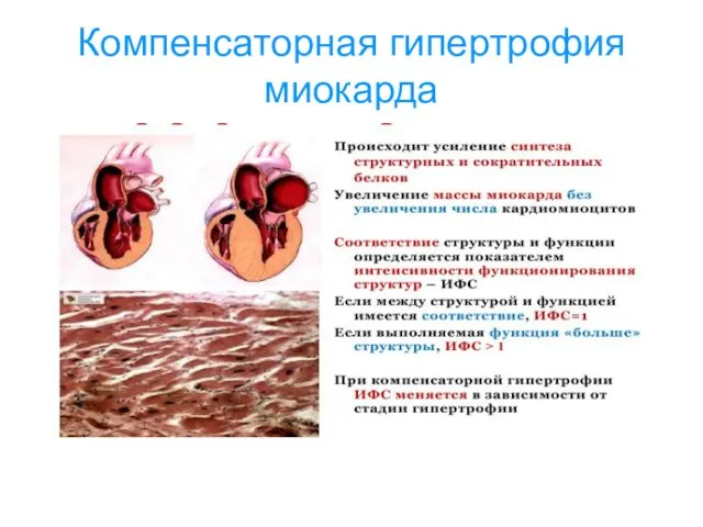 Компенсаторная гипертрофия миокарда