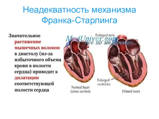 Неадекватность механизма Франка-Старлинга