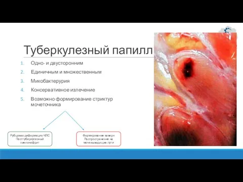 Туберкулезный папиллит Одно- и двусторонним Единичным и множественным Микобактерурия Консервативное излечение