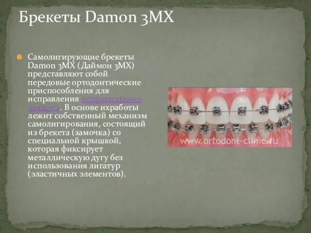 Брекеты Damon 3MX Самолигирующие брекеты Damon 3MX (Даймон 3MX) представляют собой