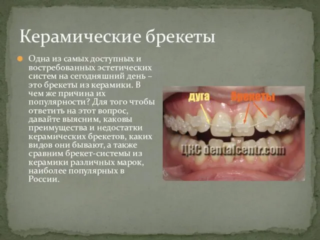 Керамические брекеты Одна из самых доступных и востребованных эстетических систем на