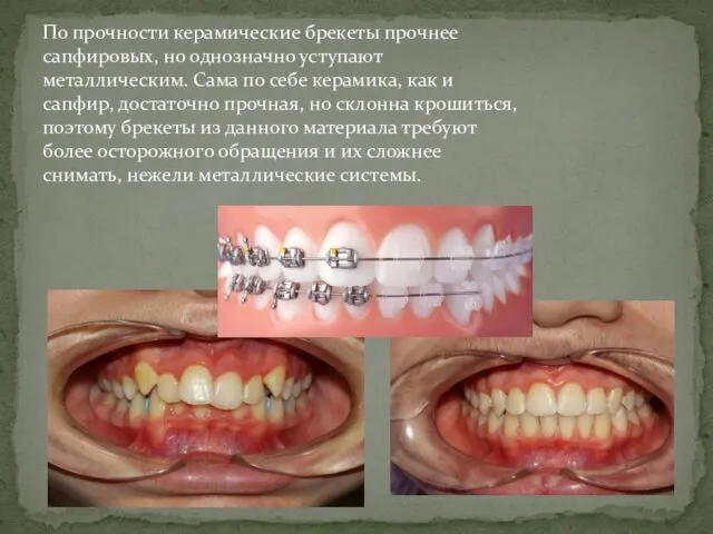 По прочности керамические брекеты прочнее сапфировых, но однозначно уступают металлическим. Сама