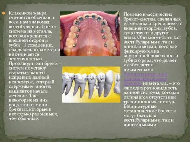 Классикой жанра считается обычная и всем нам знакомая вестибулярная брекет-система из