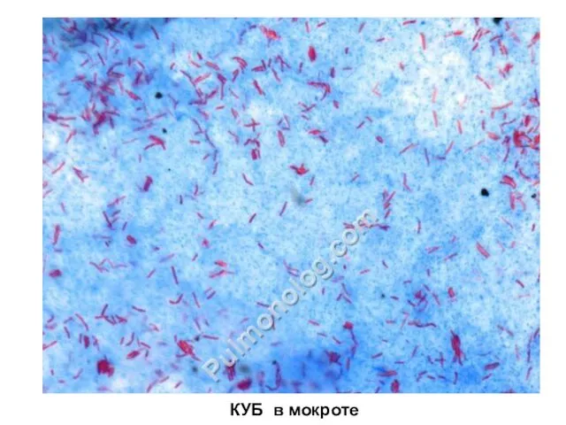 КУБ в мокроте