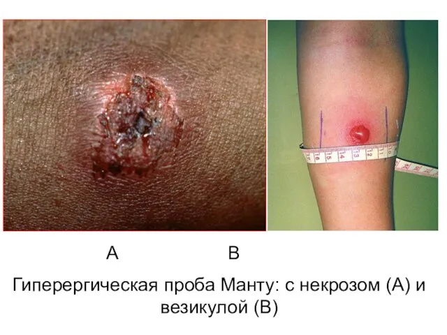 A B Гиперергическая проба Манту: с некрозом (A) и везикулой (B)