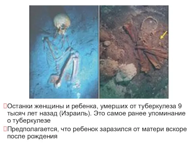 Останки женщины и ребенка, умерших от туберкулеза 9 тысяч лет назад