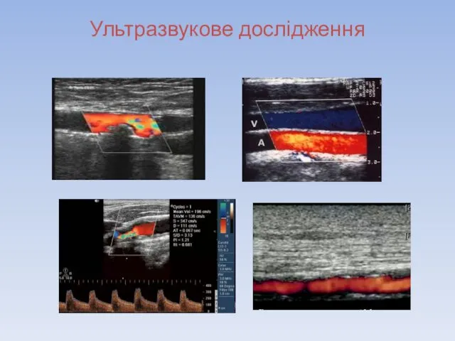 Ультразвукове дослідження