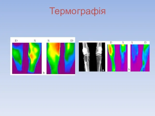 Термографія