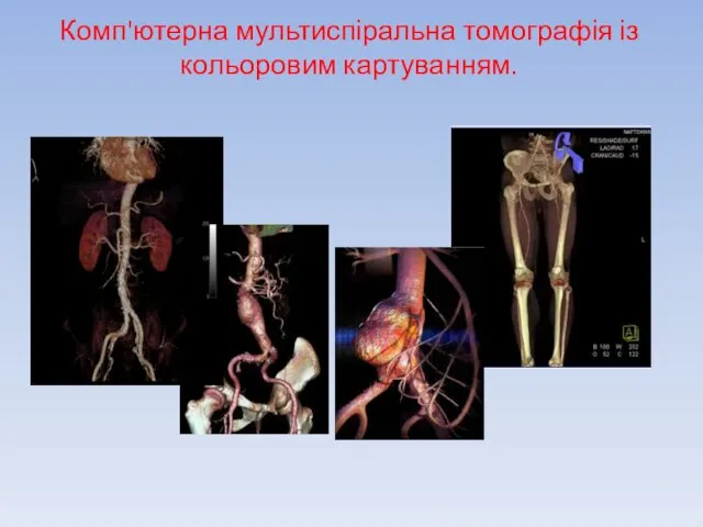 Комп'ютерна мультиспіральна томографія із кольоровим картуванням.