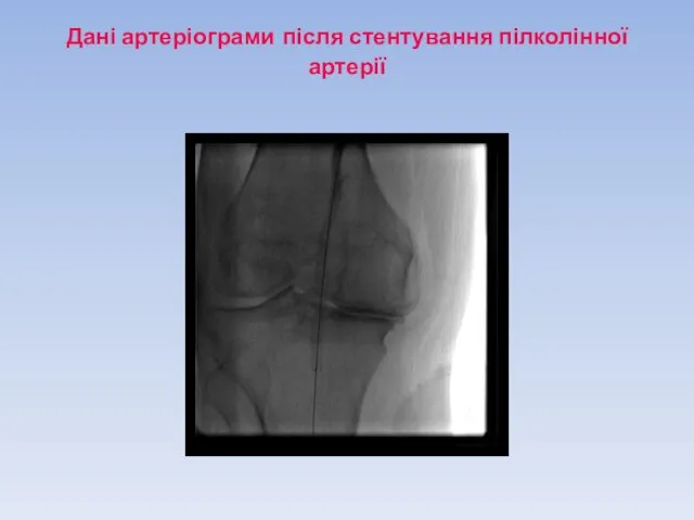 Дані артеріограми після стентування пілколінної артерії