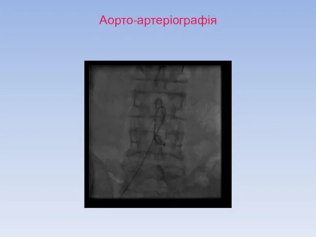 Аорто-артеріографія