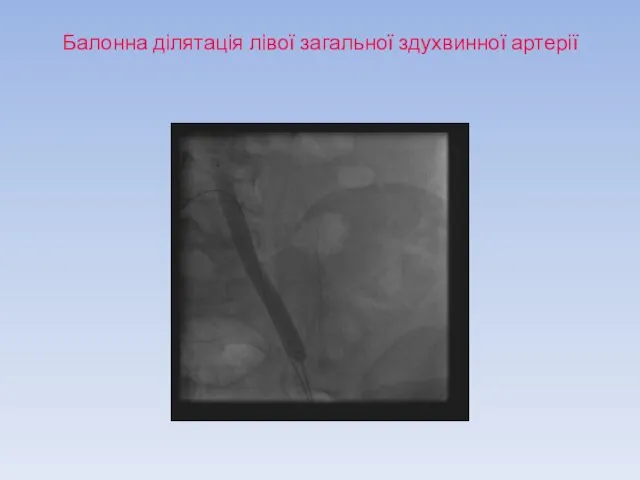 Балонна ділятація лівої загальної здухвинної артерії